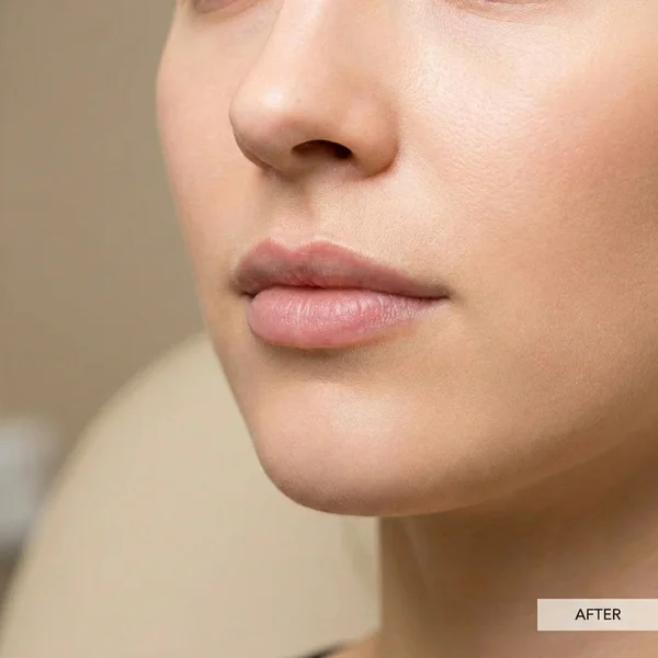 Mărire Buze cu Acid Hialuronic - Volum & Formă - După
