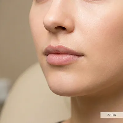 Mărire Buze cu Acid Hialuronic - Volum & Formă - După