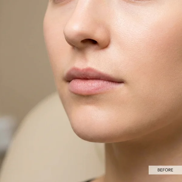 Mărire Buze cu Acid Hialuronic - Volum & Formă - Înainte