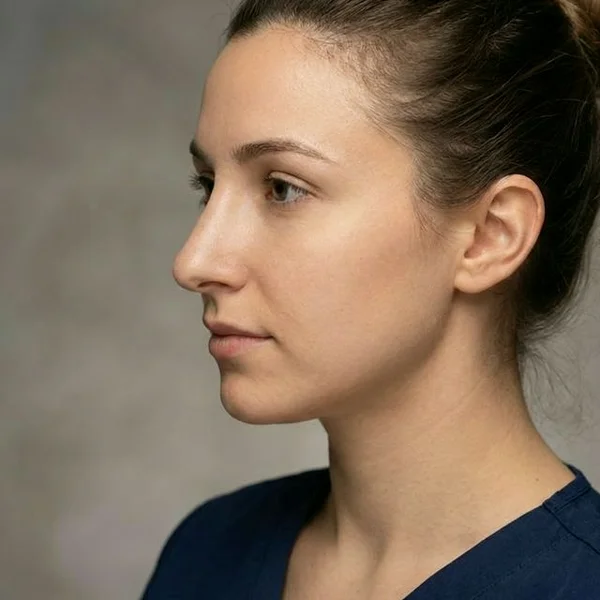 Transformare Rinoplastie - Rezultat Natural - După