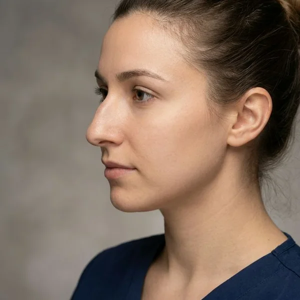 Transformare Rinoplastie - Rezultat Natural - Înainte